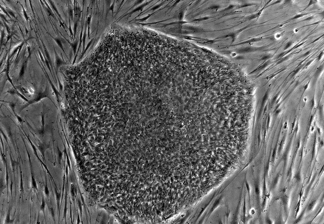 Células madre a partir de las células adultas de los propios pacientes