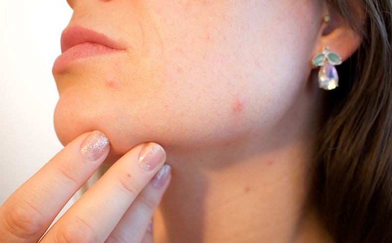 Como tratar el acne de la cara por  medio de tratamientos naturales